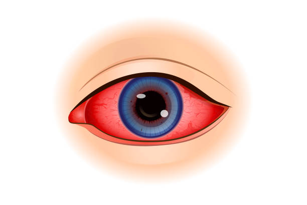 uveitis treatment